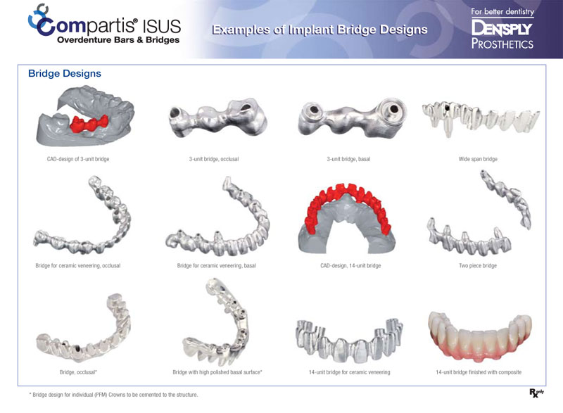 Examples of Implant Bridge Designs