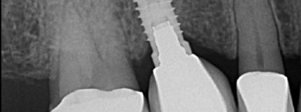 l-e-ceramic-xray-implant-supported-crown